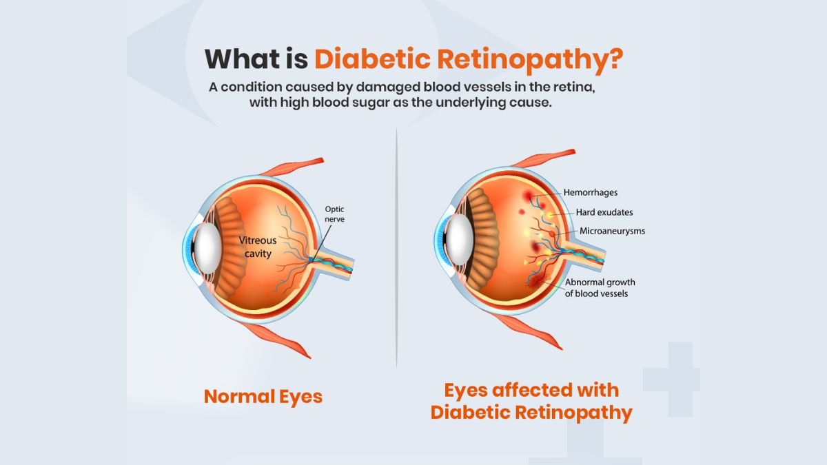 Can Diabetic Retinopathy Be Reversed? - OUR INDIA